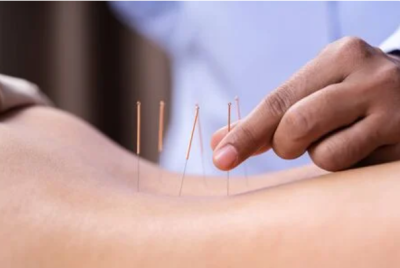 benefits of getting acupuncture